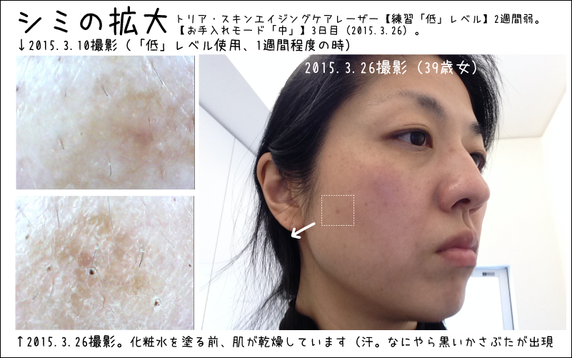 トリア・エイジングケアレーザー2週間目の肌の経過：とあるシミ部分
