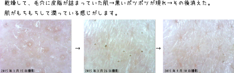 トリアスキンエイジングケアレーザーの肌経過（頬）